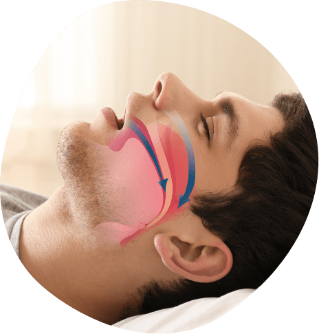 Side profile of sleeping man showing illustration of blocked airway