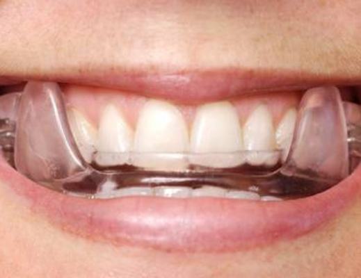 Close up of mouth with oral appliance over the teeth