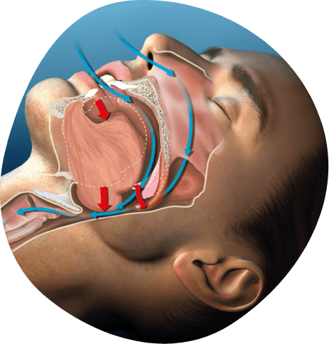 Side profile of sleeping man with illustration of blocked airway